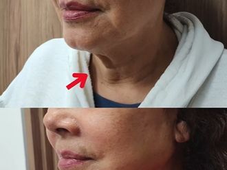 Lifting antes y después - 878420