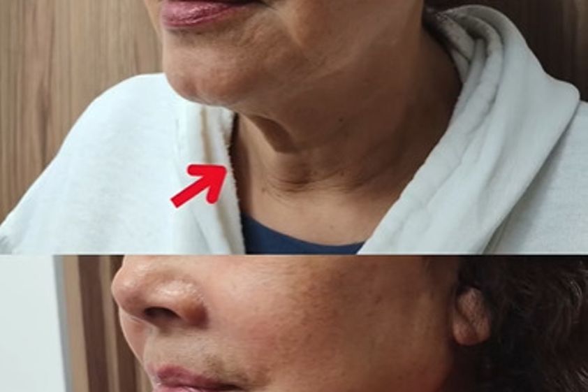 Lifting antes y después - 878420