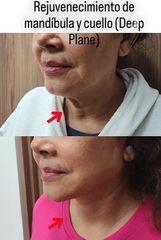 Lifting mandibula y cuello - Dr. Alejandro Cruz Segura