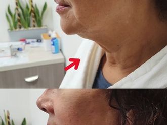 Lifting antes y después - 878421