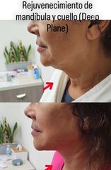 Lifting mandibula y cuello - Dr. Alejandro Cruz Segura