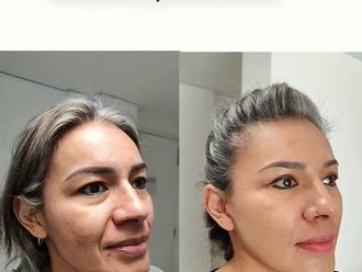 Lifting antes y después - 878422