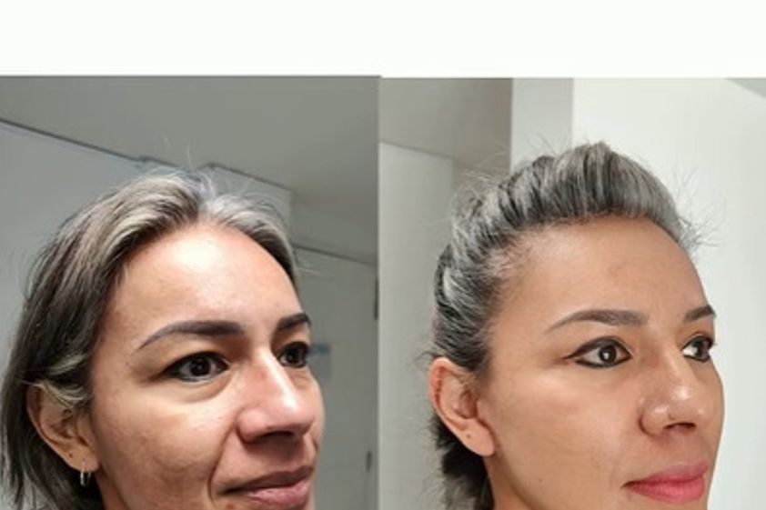 Lifting antes y después - 878422