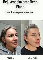 Lifting técnica Deep Plane - Dr. Alejandro Cruz Segura