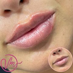 Aumento de labios - Dra. Vanessa Mordi