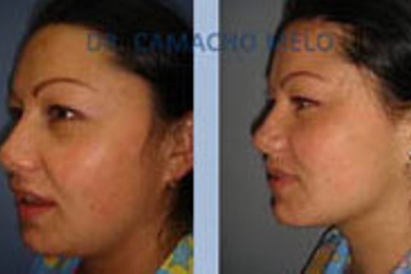 Tratamiento antiacné antes y después - 204563