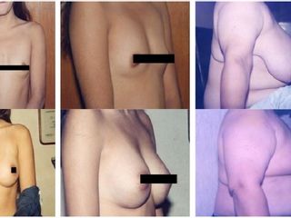 Antes y después de  Cirugía de la Glandula mamaria