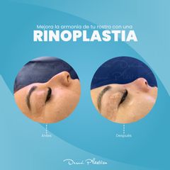 Rinoplastia - Dermi Plástica