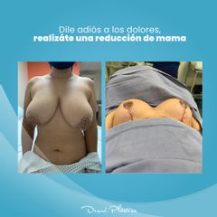 Reducción de mamas - Dermi Plástica