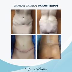Abdominoplastia - Dermi Plástica