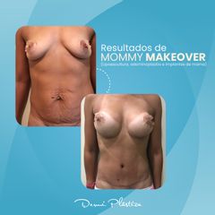 Mommy makeover - Dermi Plástica