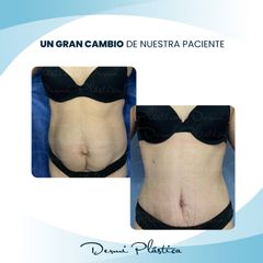 Abdominoplastia - Dermi Plástica