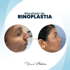 Rinoplastia - Dermi Plástica