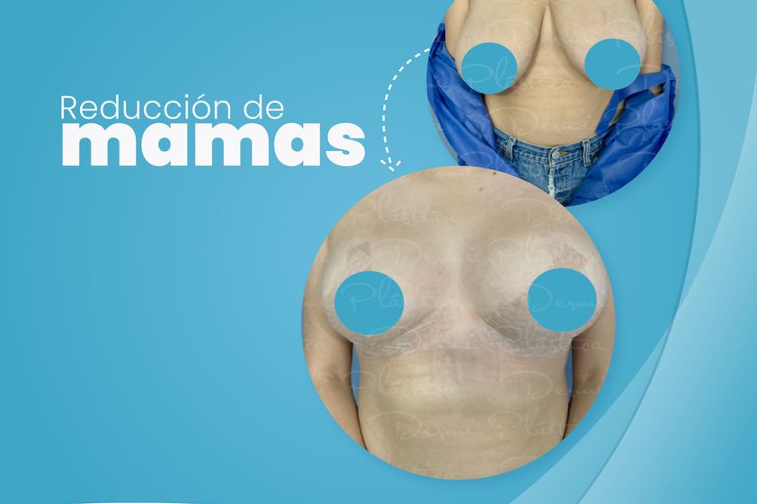 Reducción de mamas antes y después - 787987