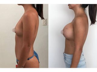 Antes y después de Aumento de busto - Topmedical