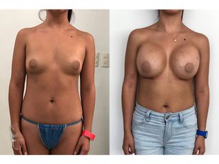 Antes y después de Aumento de busto - Topmedical