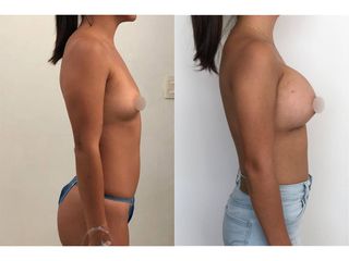 Antes y después de Aumento de busto - Topmedical