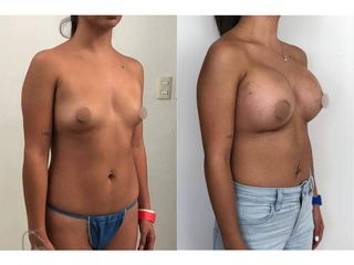 Antes y después de Aumento de busto - Topmedical