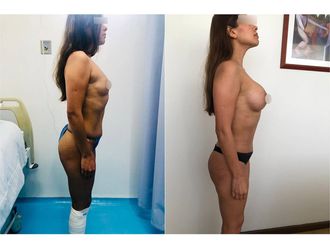 Lipoescultura - 788106