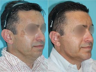 Antes y después de Cirugía de papada - Topmedical