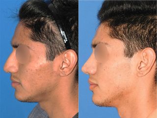 Antes y después de Rinoplastia - Topmedical