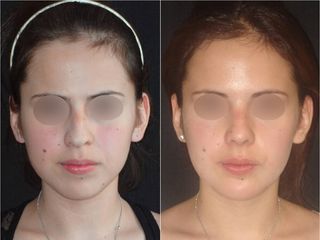 Antes y después deRinoplastia - Topmedical