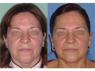 Antes y después deRejuvenecimiento facial - Topmedical