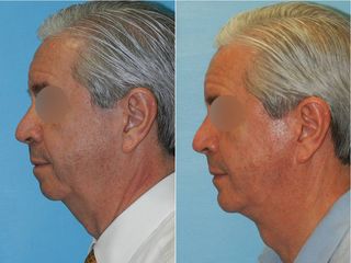 Antes y después de Cirugía de papada - Topmedical