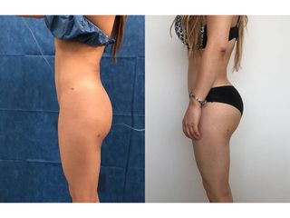 Antes y después de Liposucción - Topmedical