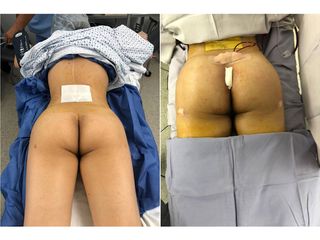 Antes y después de Gluteoplastia - Topmedical