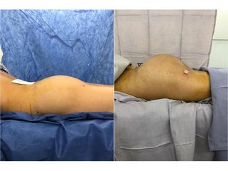 Antes y después de Gluteoplastia - Topmedical