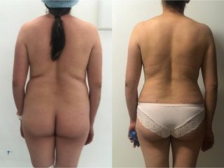 Antes y después de Liposucción - Topmedical