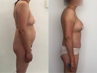 Antes y después de Liposucción - Topmedical