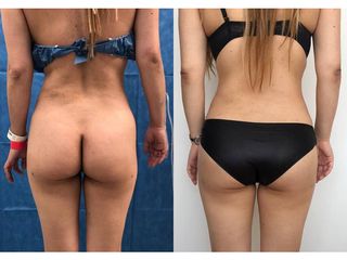 Antes y después de Liposucción - Topmedical