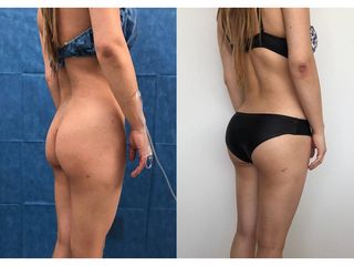 Antes y después de Liposucción - Topmedical