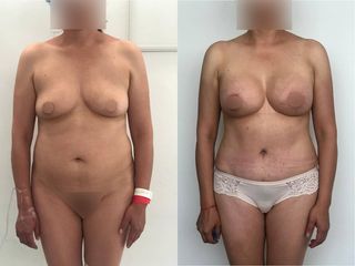 Antes y después de Lipoescultura - Topmedical
