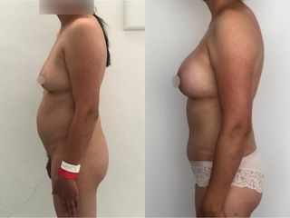 Antes y después de Aumento de busto - Topmedical