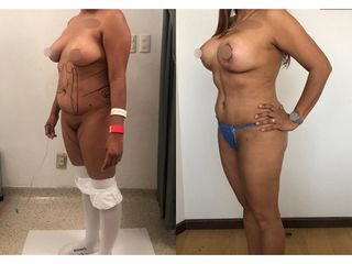 Antes y después de Lipoescultura - Topmedical