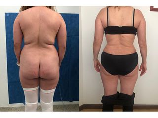 Antes y después de Lipoescultura - Topmedical