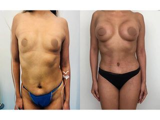 Antes y después de Lipoescultura - Topmedical