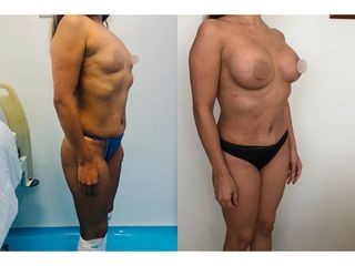 Antes y después de Lipoescultura - Topmedical