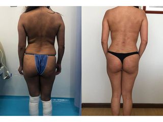 Antes y después de Lipoescultura - Topmedical