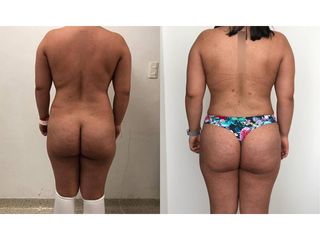 Antes y después de Lipoescultura - Topmedical