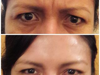 Antes y después de un rejuvenecimiento facial con Bótox