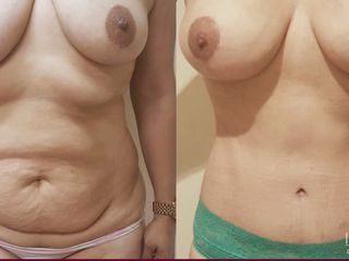 Antes y después de Lipectomia