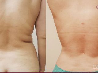 Antes y después de liposuccion