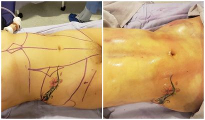 Liposucción - Dr. Rodolfo González Reynoso