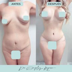 Lipoescultura - Dr. Rodolfo González Reynoso