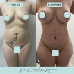 Lipoescultura - Dr. Rodolfo González Reynoso