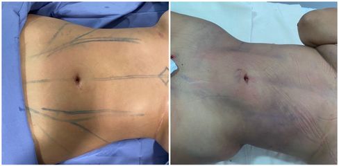 Liposucción - Dr. Rodolfo González Reynoso